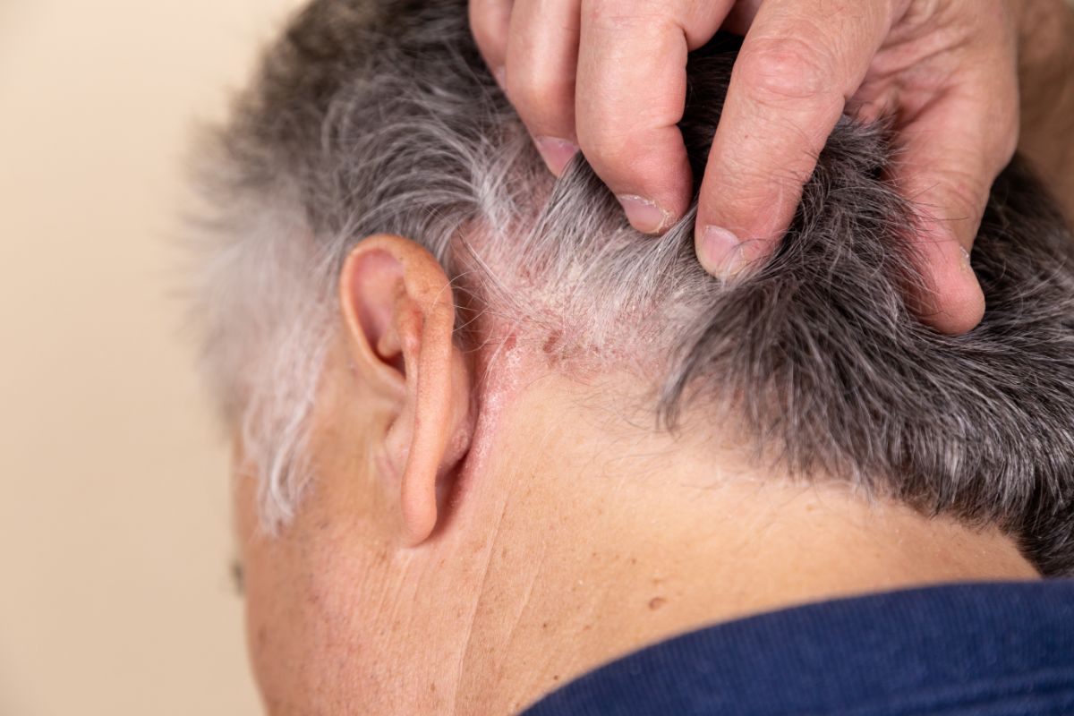 Muž s kožným ochorením vo vlasovej časti hlavy